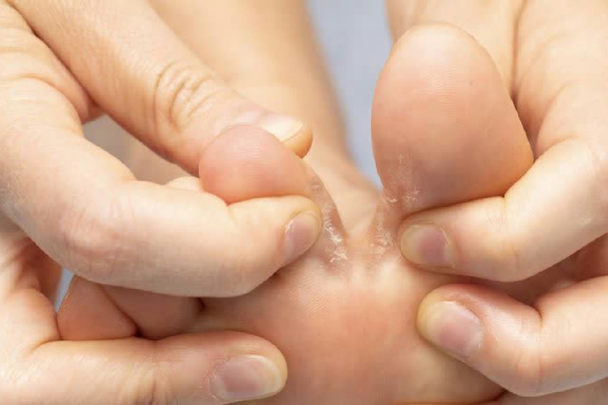 Funghi della pelle: quali riconoscere subito, come evitarli e le strategie per eliminarli